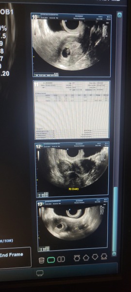 Brown/Pink Discharge - nearing end of 7 weeks