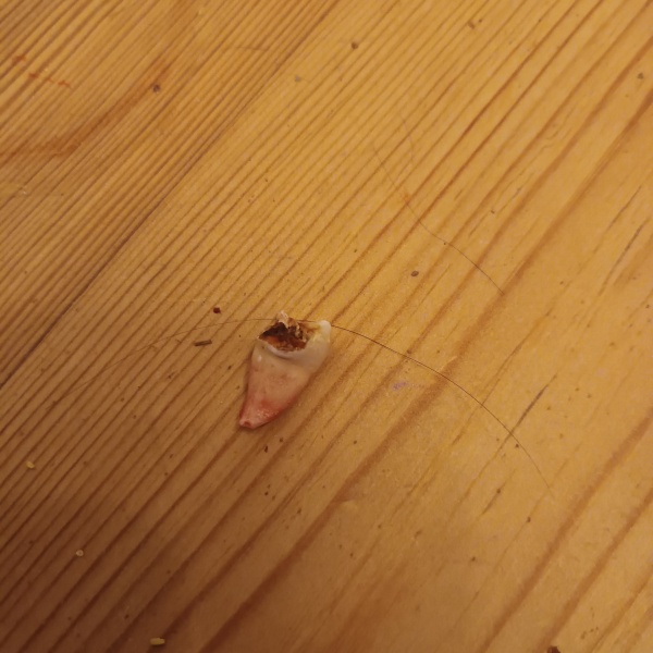 Anyone want to see my extracted tooth? *Trigger Warning* Photo attached
