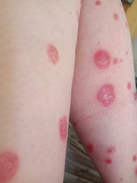Psoriasis -advice before GP appointment 