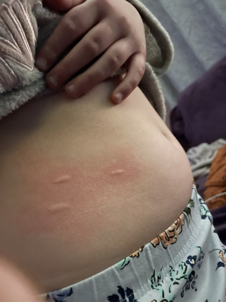 What is this rash?