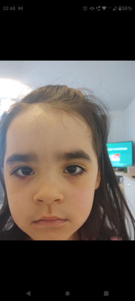 Toddler with chalazion on eye (picture)