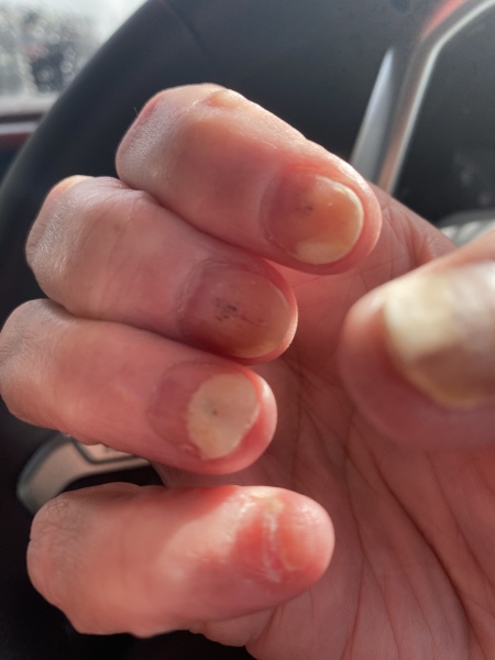 Gel nails… what condition are your nails after the gels come off? 