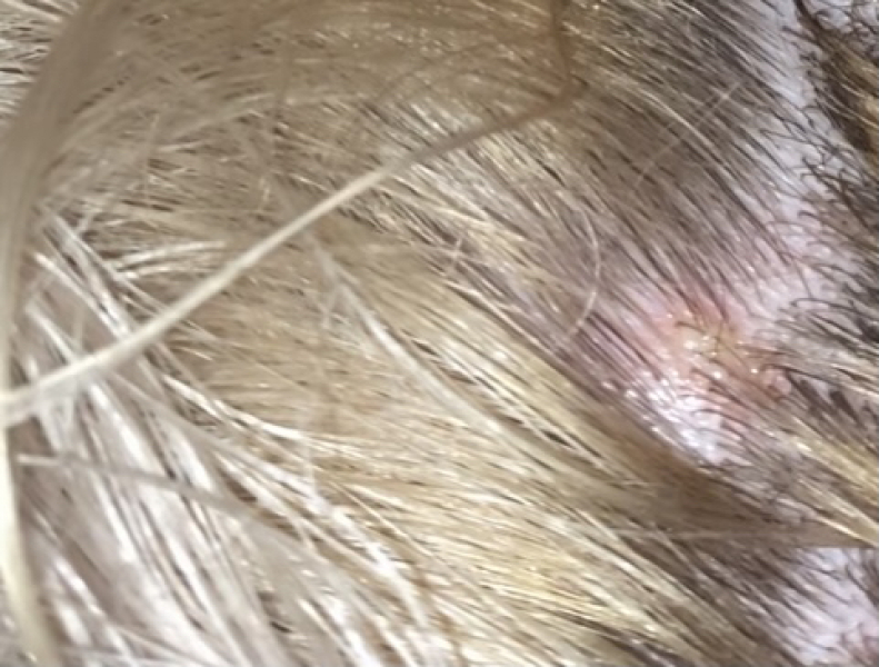 Lump on neck!