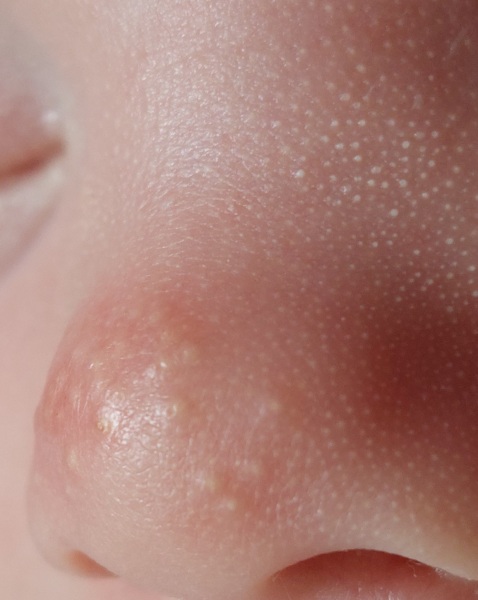 Gentlest way to clear baby's pores? (Pic)