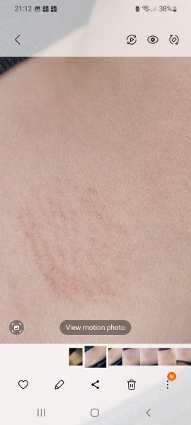 Rash