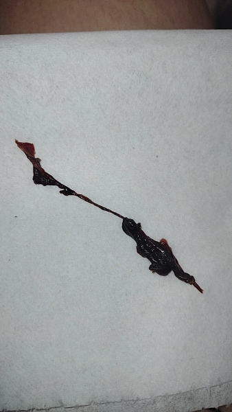 Miscarriage or blood clot? TMI PIC 