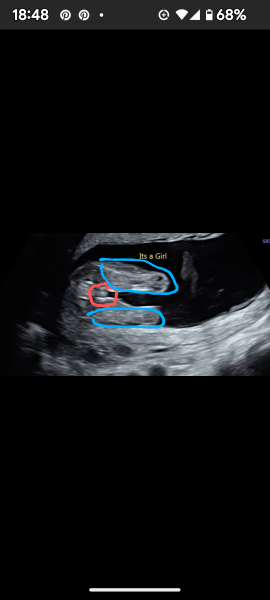 I think I was told wrong sex for baby - am I crazy? 