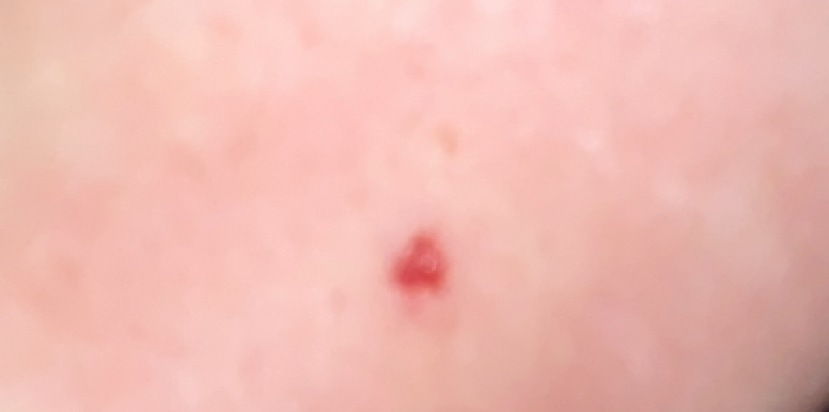 Red spot on stomach? Possibly related to antidepressant?