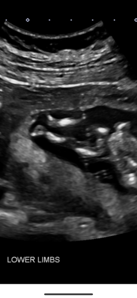 Nub and potty shot guesses (13 weeks 4 days)