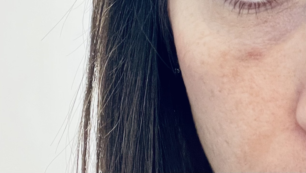 Retinol mark on face 