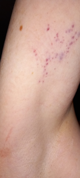 Purpura from HRT