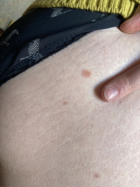 Mole Anxiety please help me!