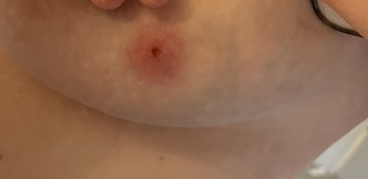 Red mark/hole on breast TMI pics sorry