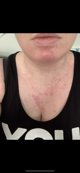 Exercise induced allergic reaction