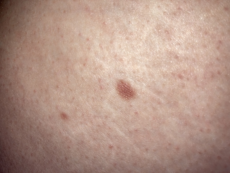 Mole Anxiety please help me!