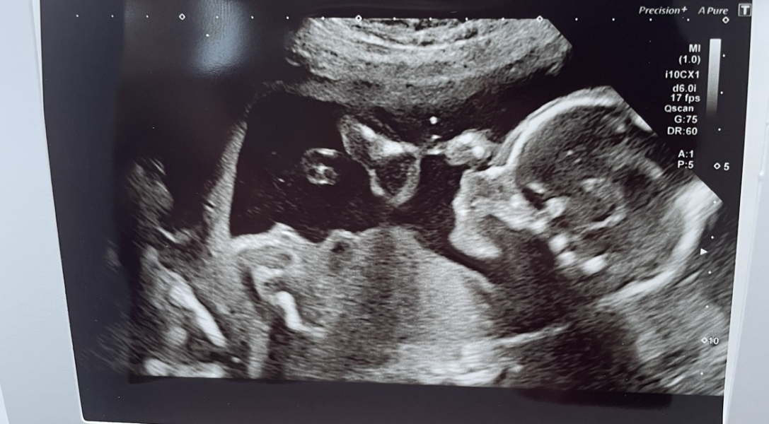 Boy or girl? Nub/skull theory