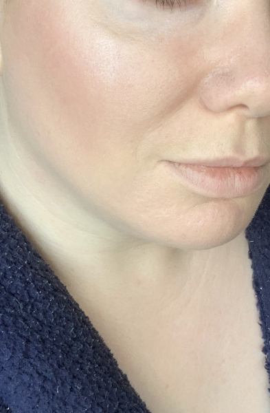 Nasolabial folds at 32?