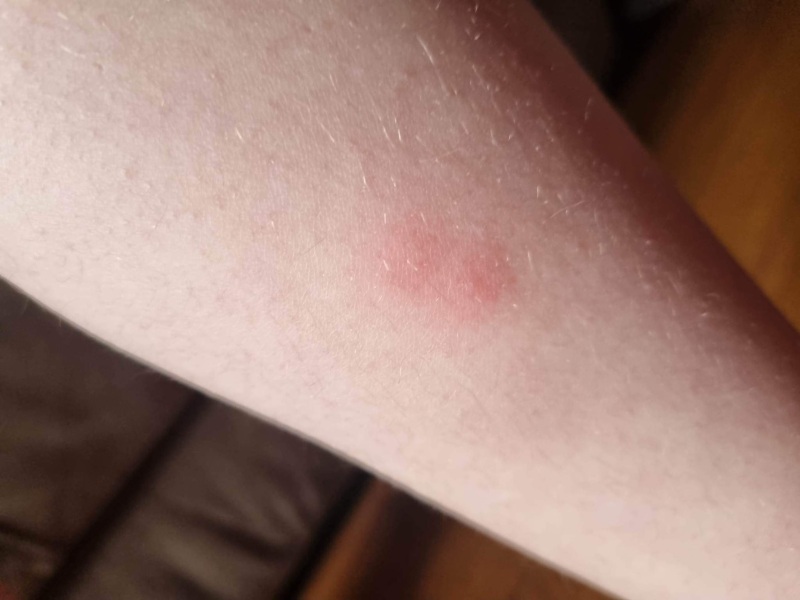 Chicken pox or?
