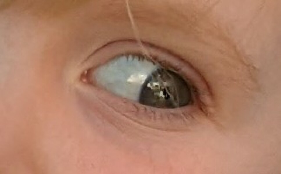 My eyeballs have changed colour