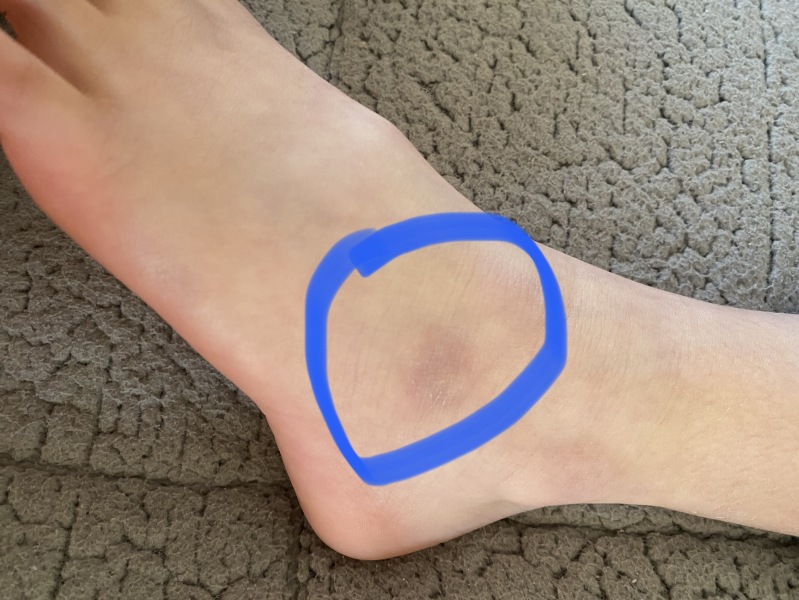 Please help reassure me… daughter has had this bruise for 2 months.