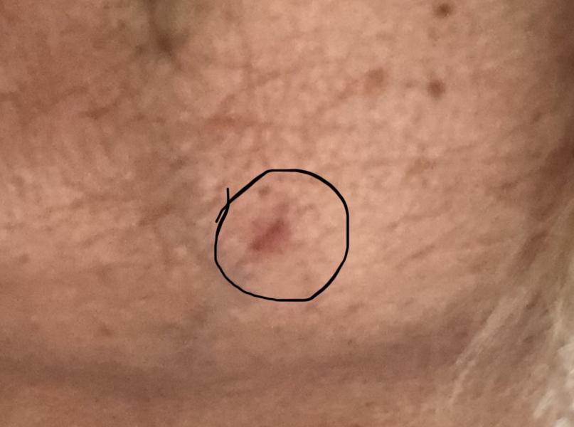 To tell you all to check your moles! (and wear good SPF) 