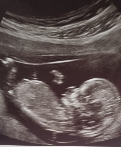12 week scan nub theory help? 