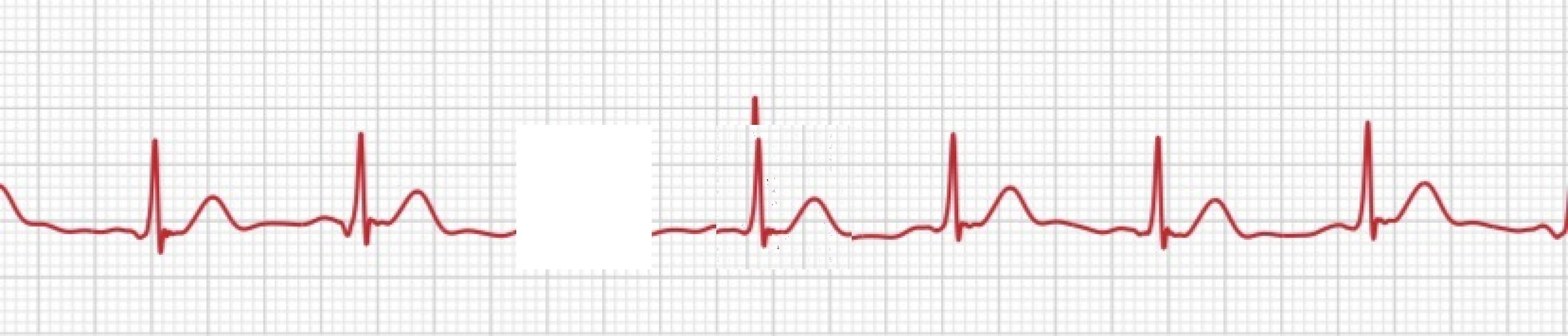 Any ECG/heart/cardio experts?