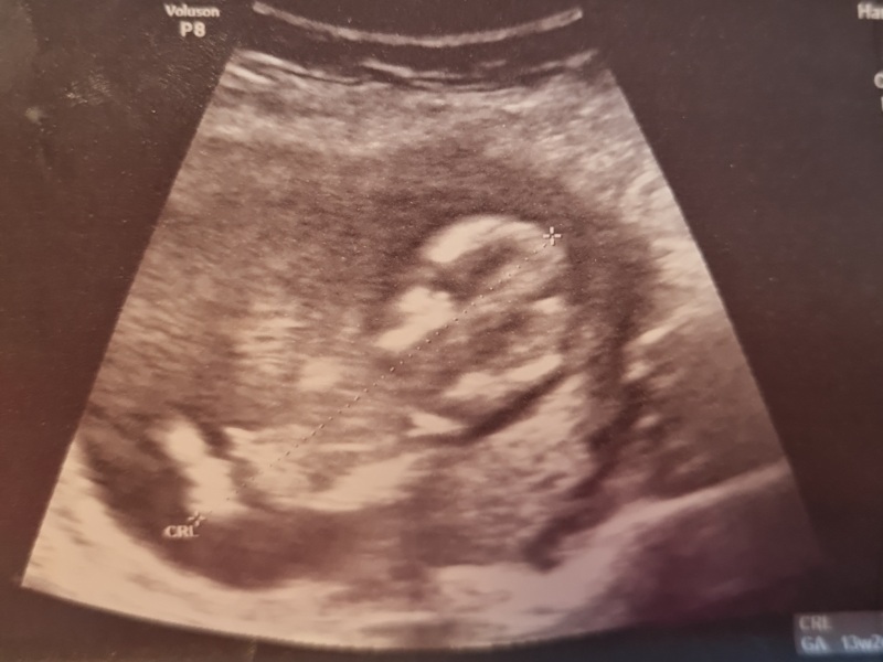 Is this a boy nub?