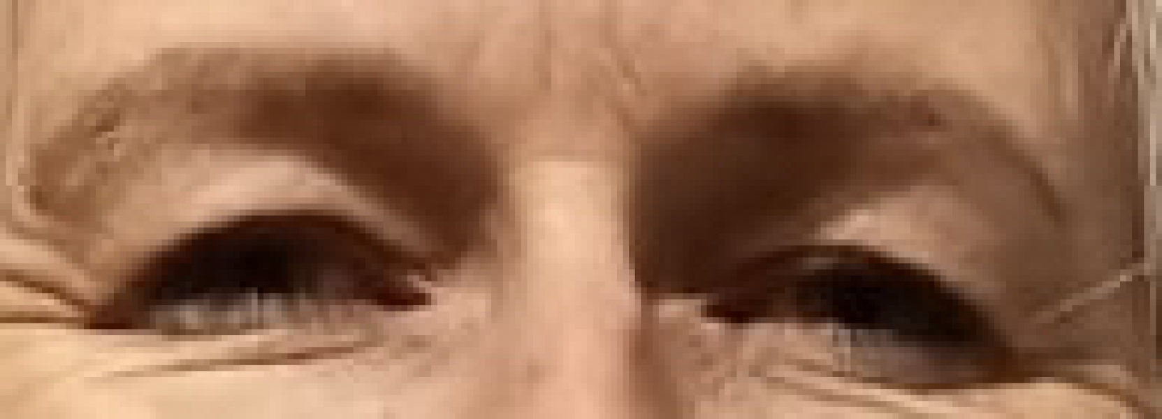 Upper eyelid surgery