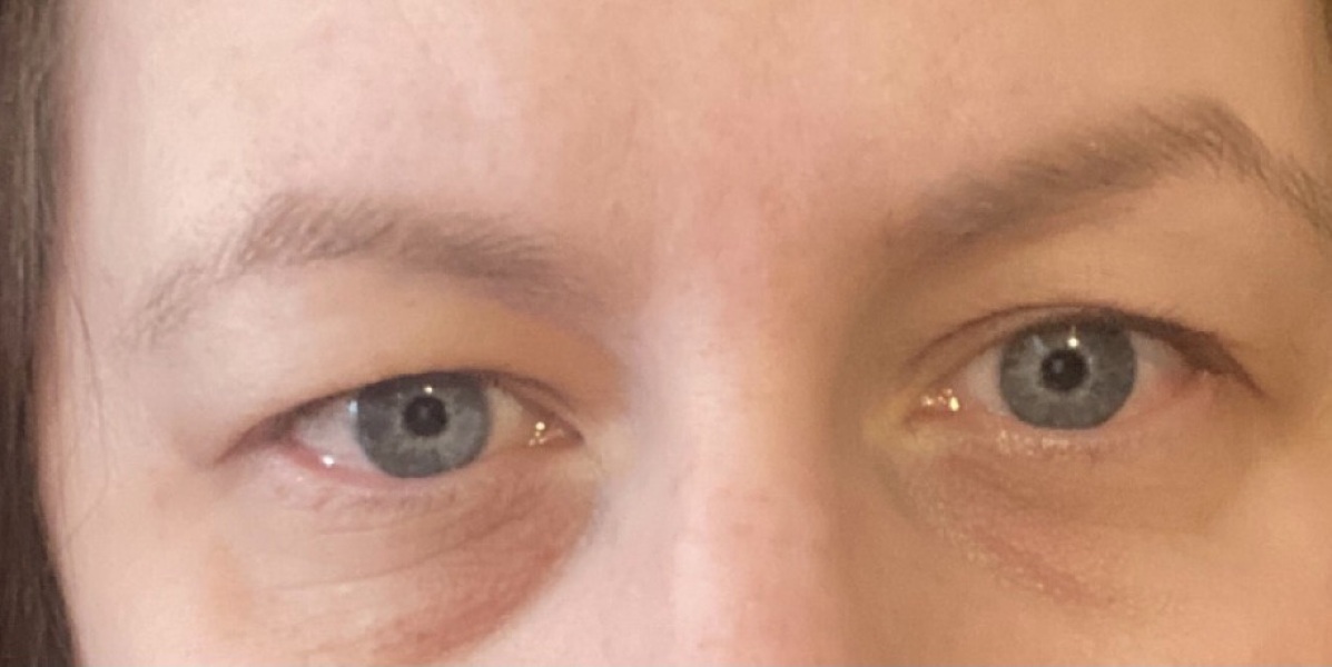 What's wrong with my eye ?