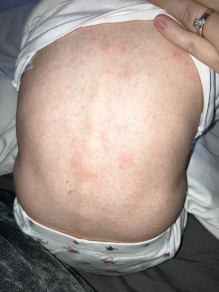 Is this chicken pox?