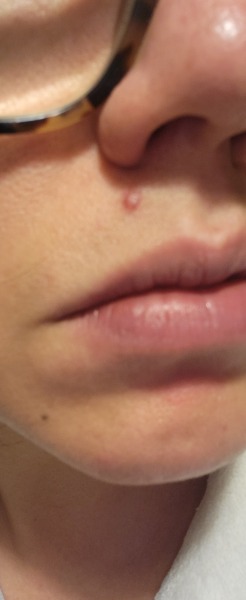Skin cancer worries