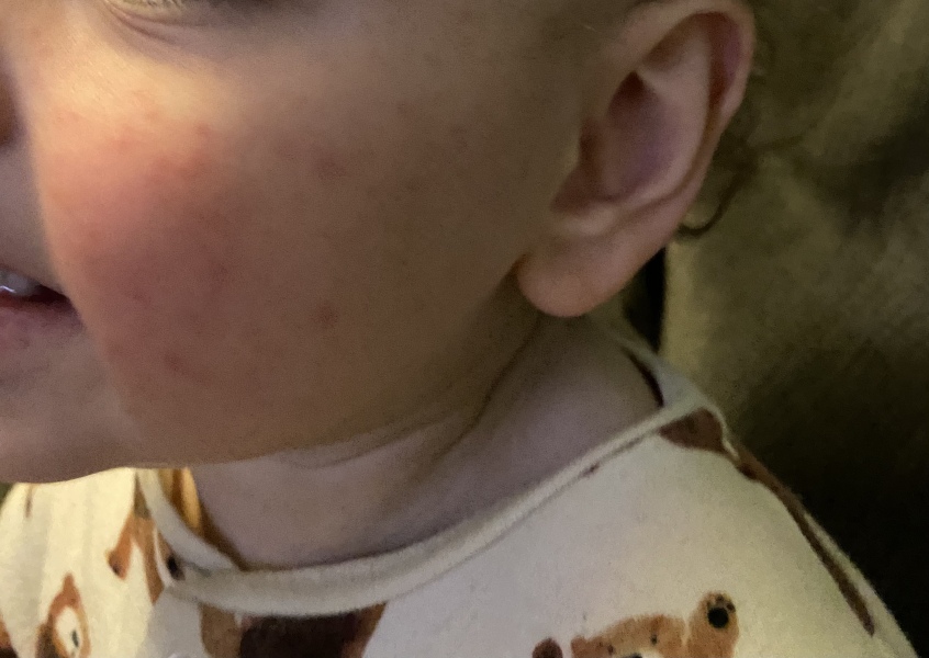 Chicken pox ? 