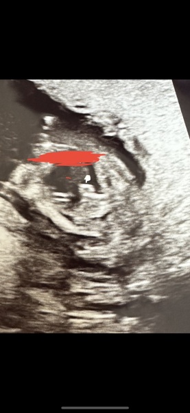 Potty shot ultrasound