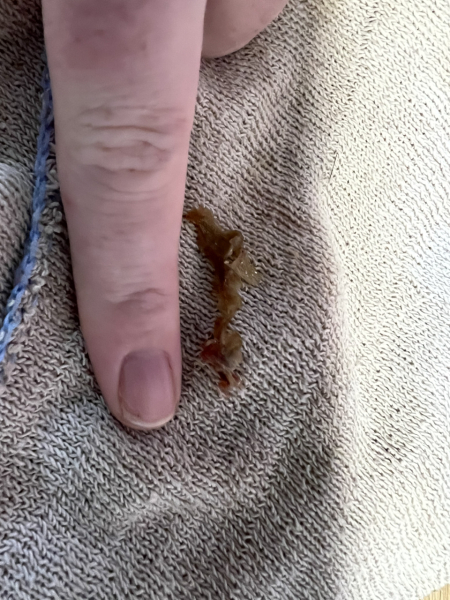 The best thing your body has produced *warning-grim content not suitable for weak-stomached persons*