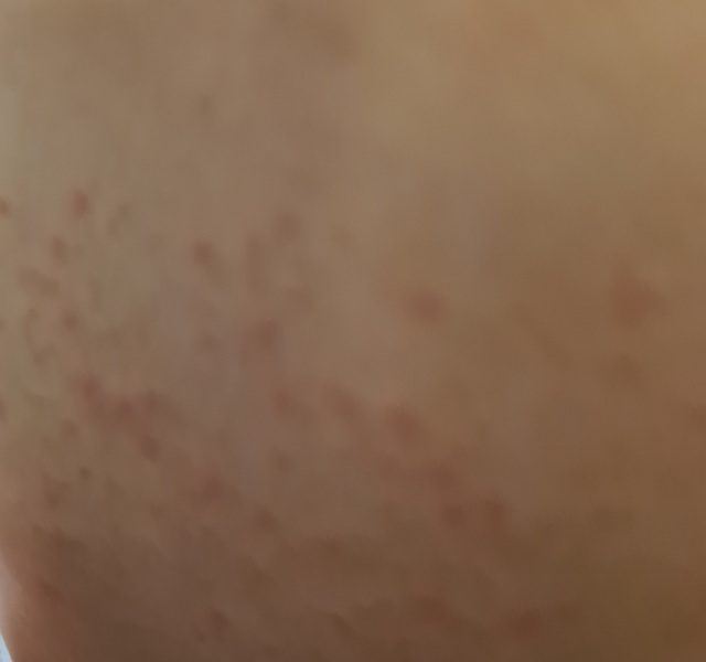 Is this chickenpox?