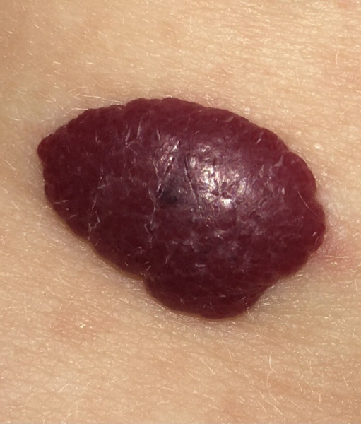 Strawberry birthmark on baby developed black bit in the middle ?