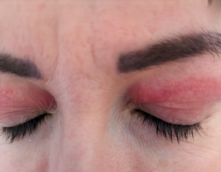 Has anyone been left with scarring after plasma pen/fibroblast?