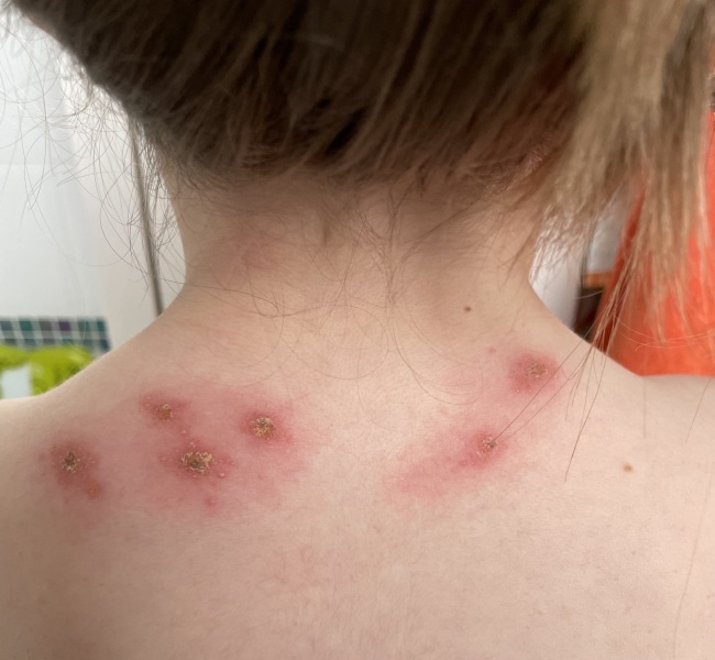 What has bitten my child?