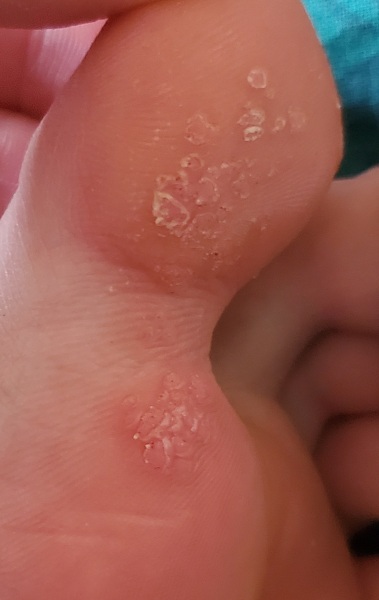 TW - pic.  Bumps on big toe.