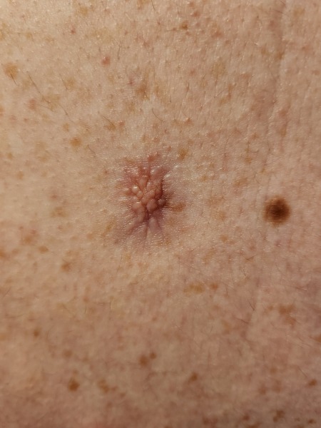 What is this on my back? *warning* Picture included 
