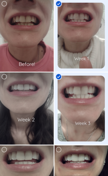 Teeth whitening 