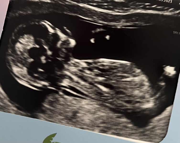 First cycle - IVF / ICSI - Day 4 