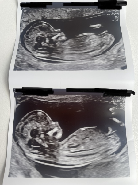 Girl or boy?! Confused what is nub…