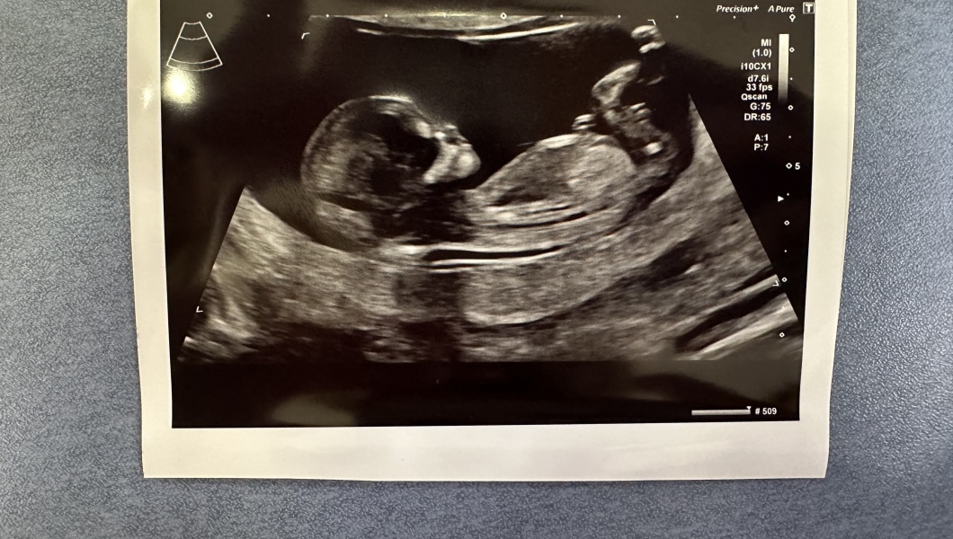 12 weeks 5 days - Blue or Pink? 