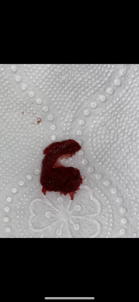 Warning photo! Is this a miscarriage or a big blood clot