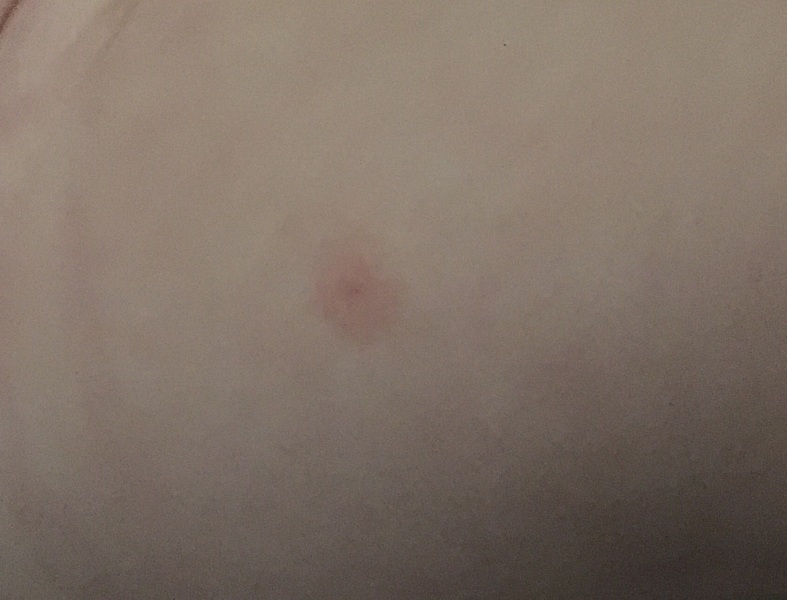 Red swelling round my baby's vaccination site