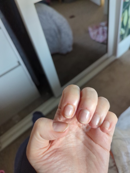 Nail biting help
