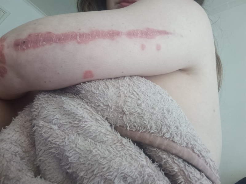 Psoriasis -advice before GP appointment 