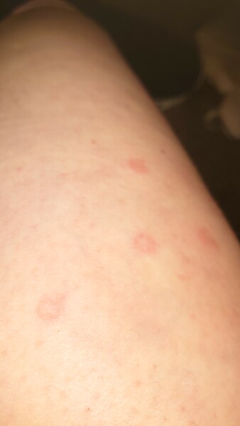 red circular patches that won't go away on legs